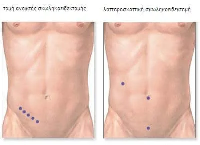 Λαπαροσκοπική Σκωληκοειδεκτομή